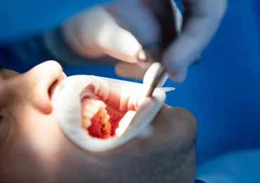 tooth extraction