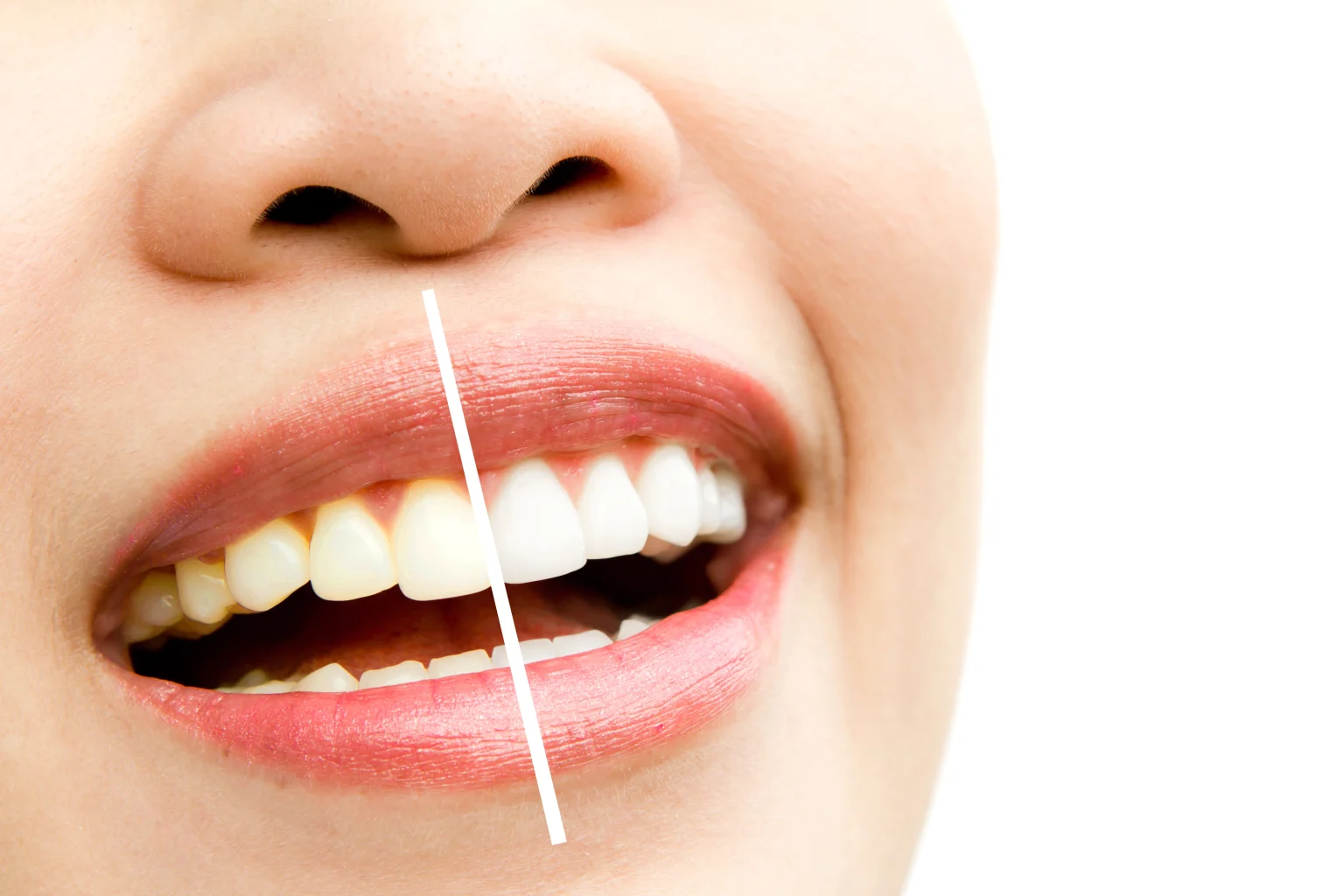tooth whitening