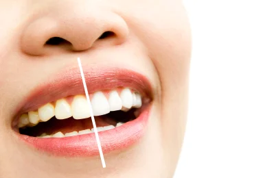 tooth whitening
